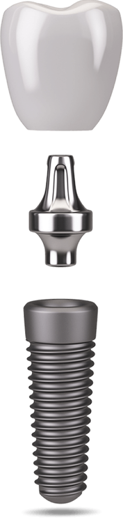 dental implant model