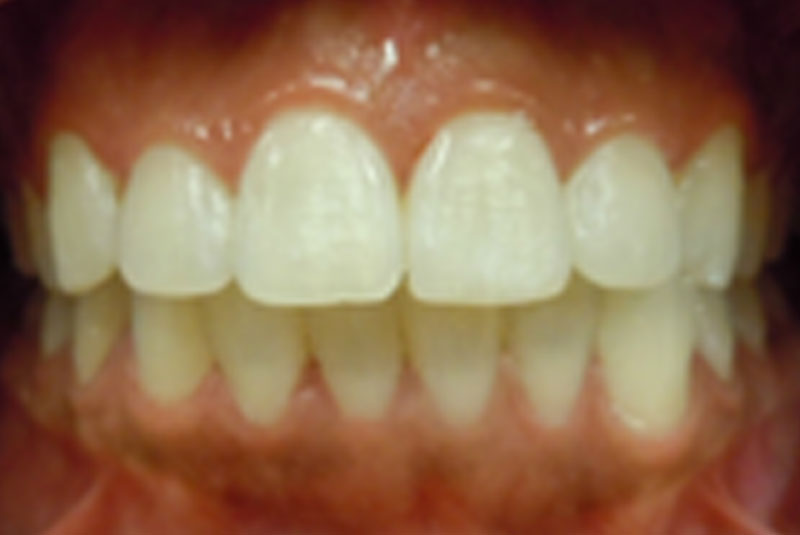 after fast braces