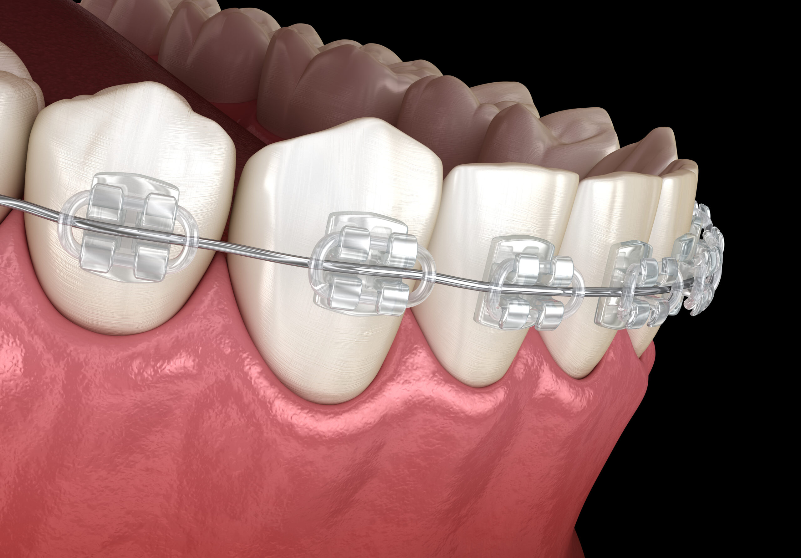 FASTBRACES