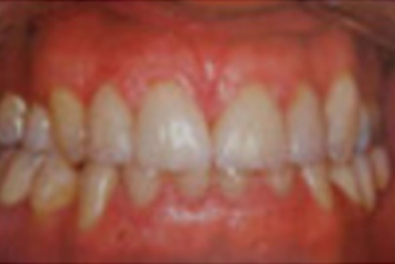 after porcelain crowns