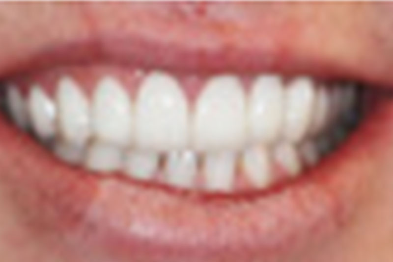 after veneers and teeth whitening