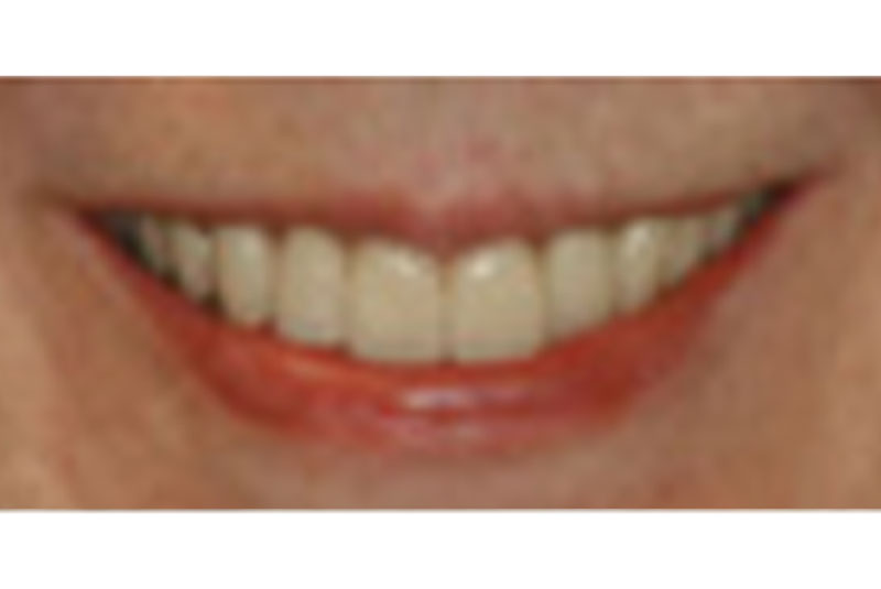 after before veneers and bridges