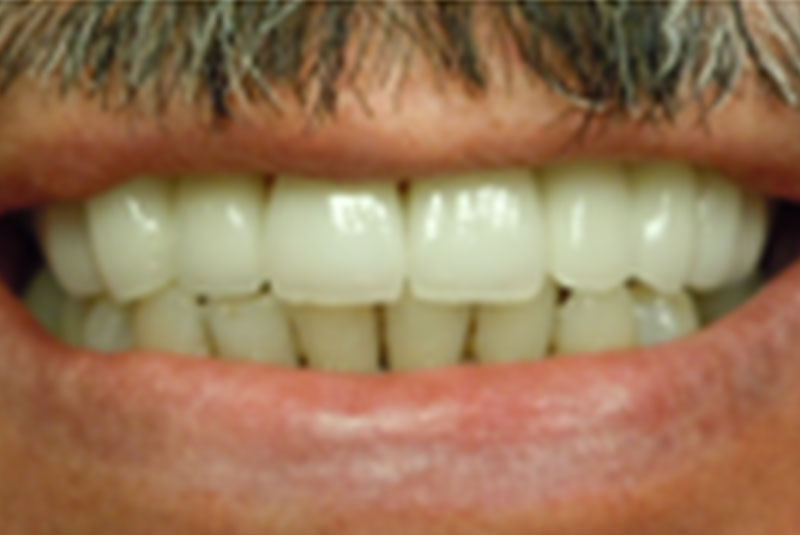 after smile makeover