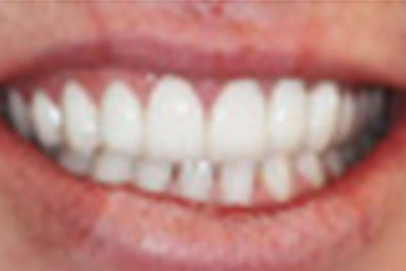 after dental bridges