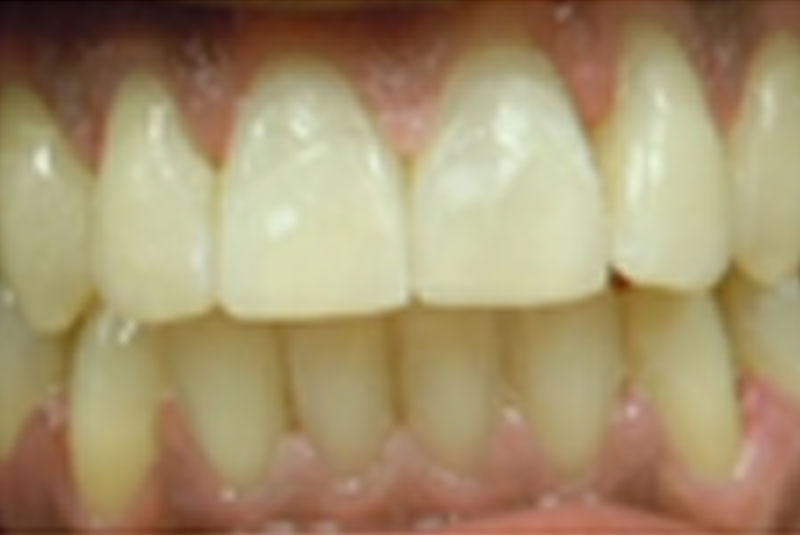 after fast braces