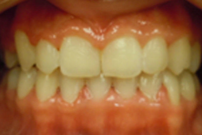 after fast braces