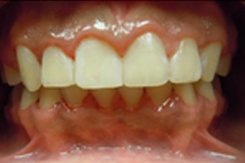 after fast braces