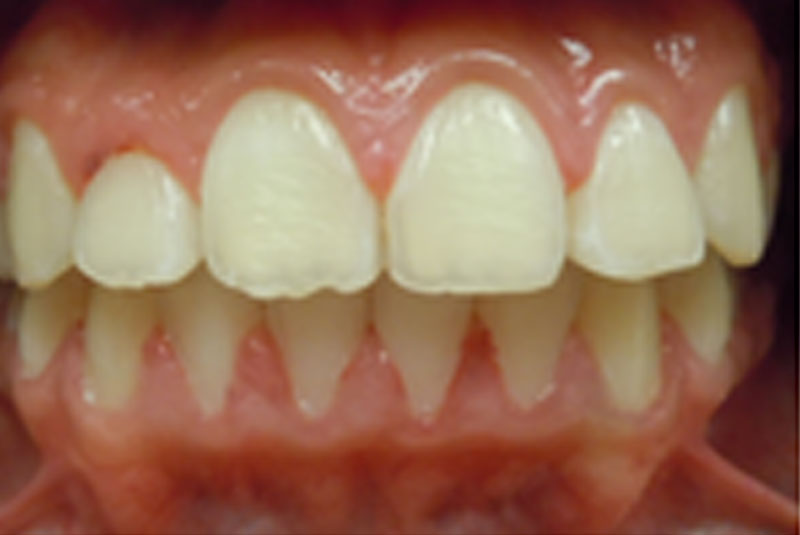 after fast braces