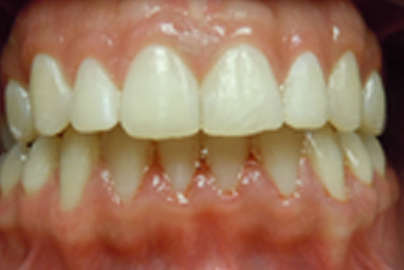after fast braces