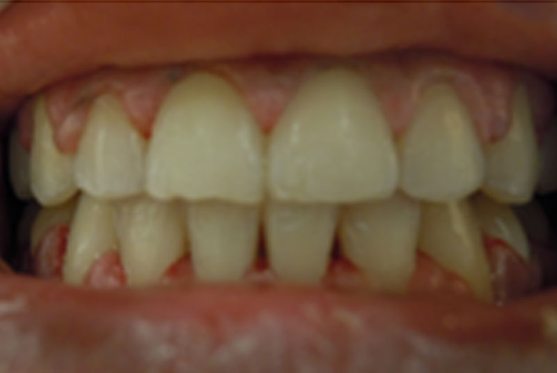 after fast braces