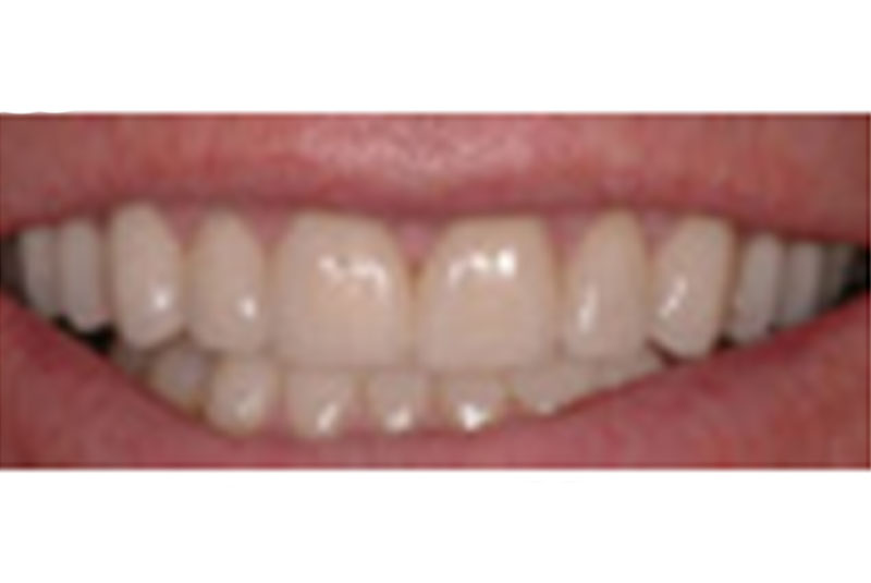 after porcelain crowns