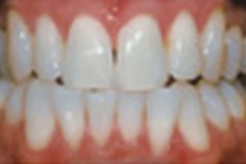 after veneers and teeth whitening