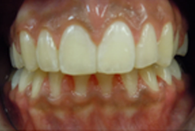 after fast braces