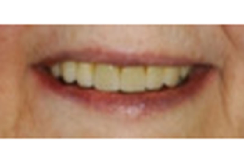 after porcelain crowns