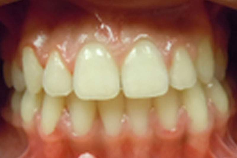 after fast braces