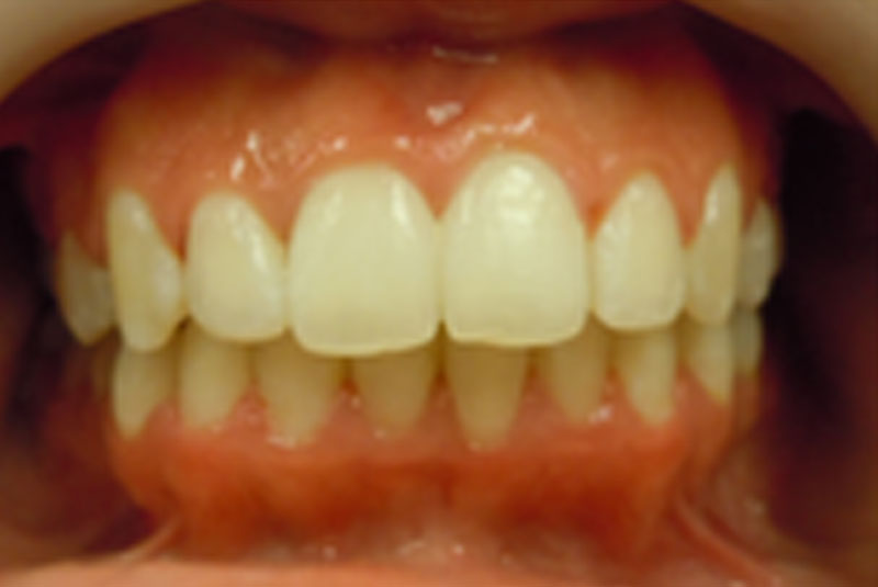 before fast braces
