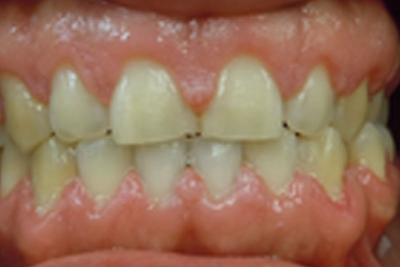 after fast braces