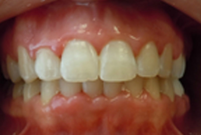 after fast braces