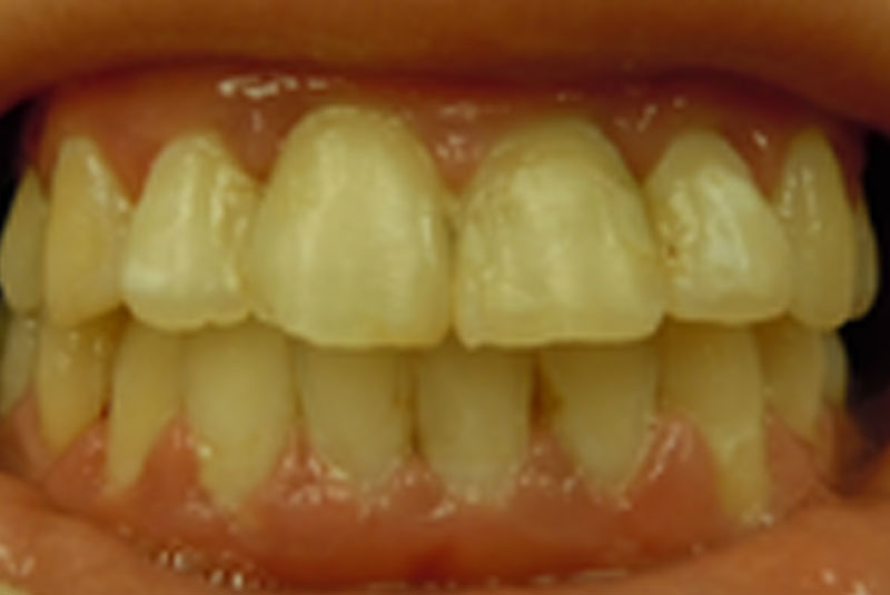 after fast braces