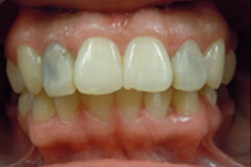 after fast braces