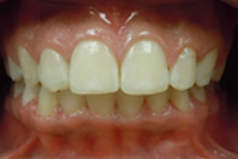 after fast braces