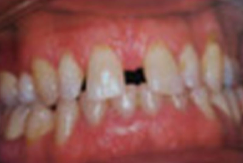 before porcelain crowns