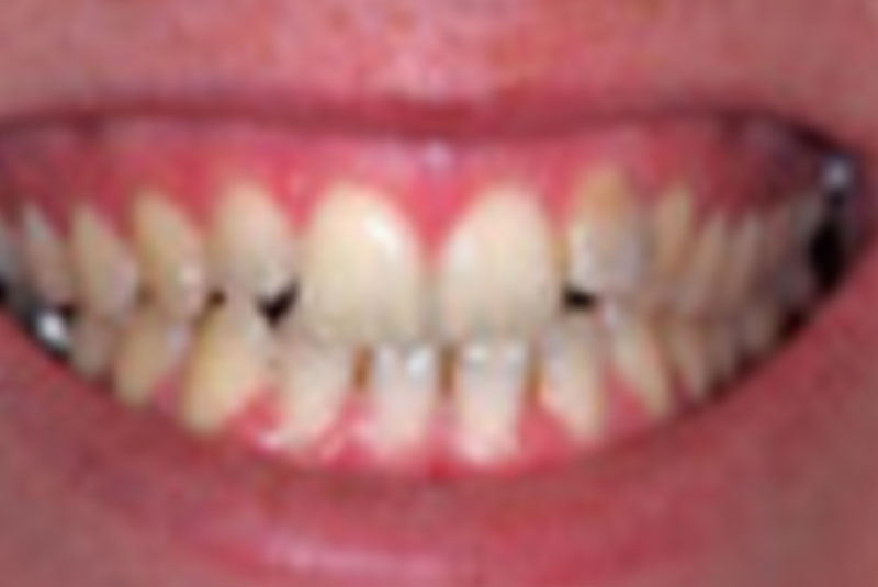 before veneers and teeth whitening