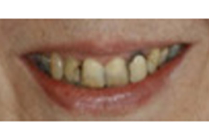 before veneers and bridges