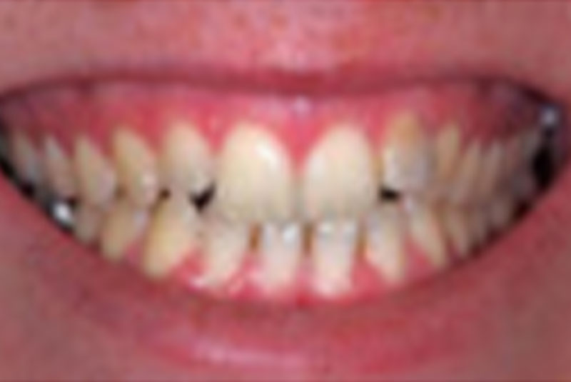before dental bridges