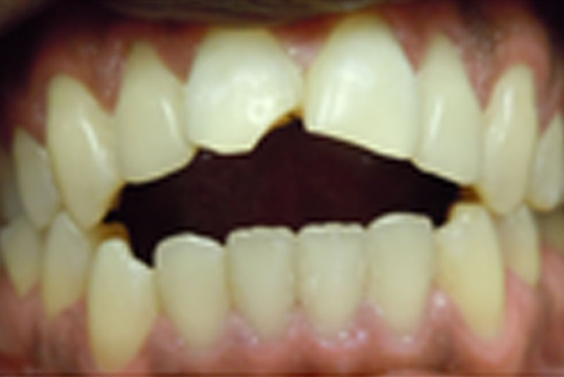 before fast braces