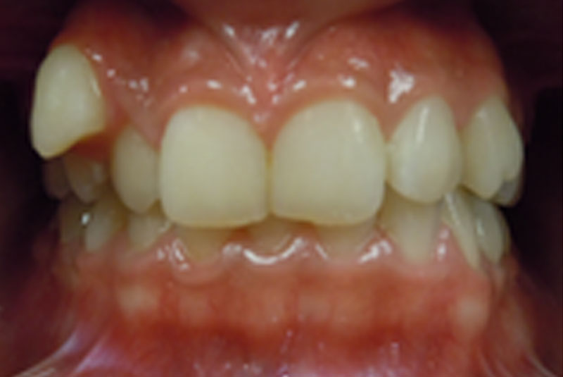 before fast braces