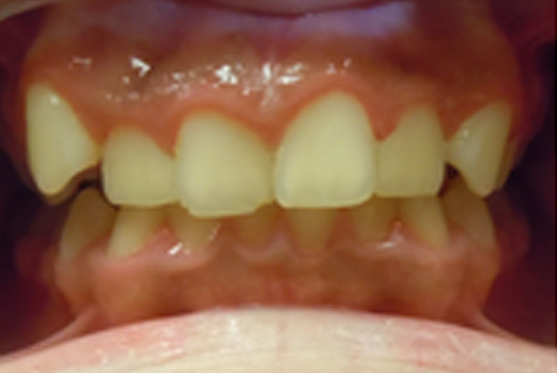 before fast braces
