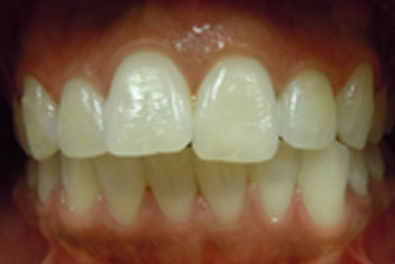 before fast braces