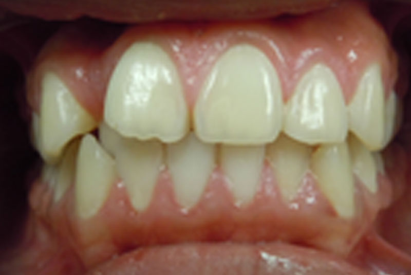 before fast braces
