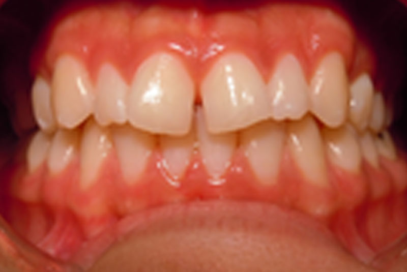 before fast braces