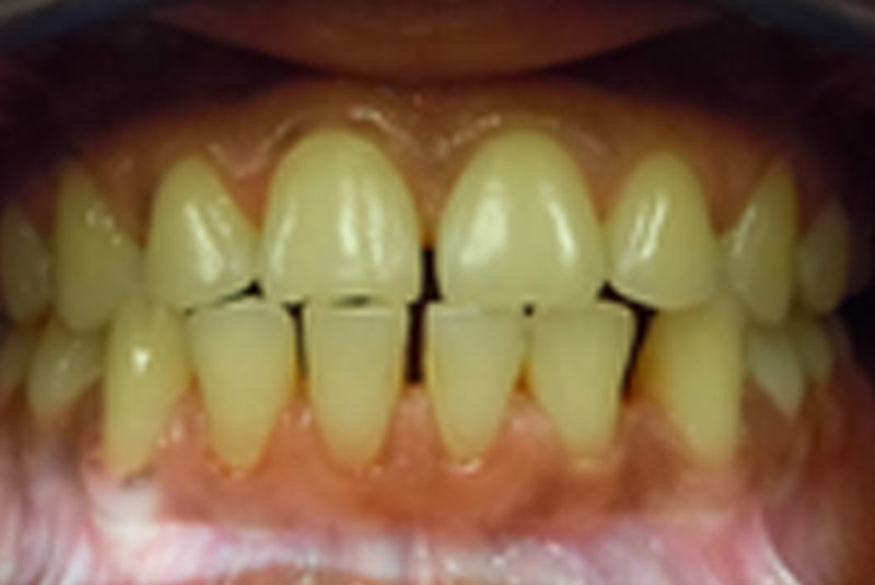 before fast braces