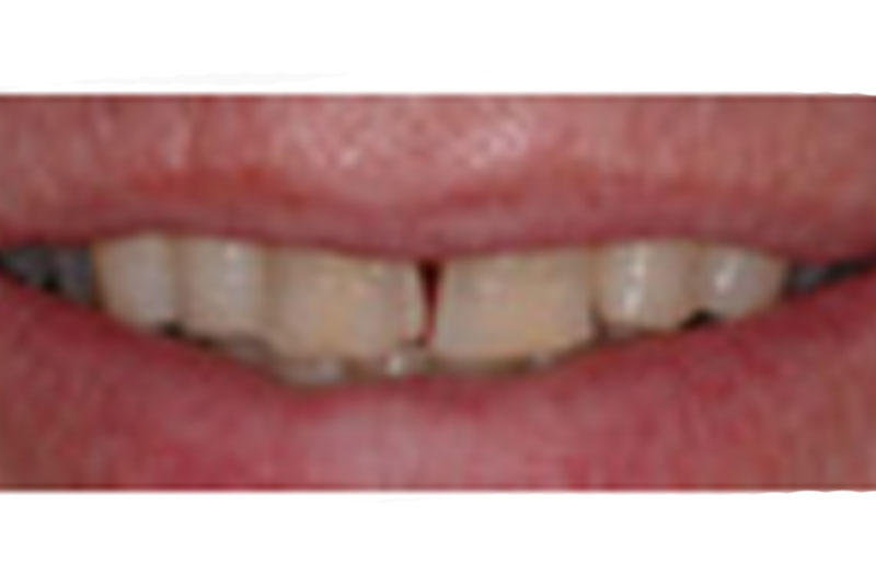 before porcelain crowns