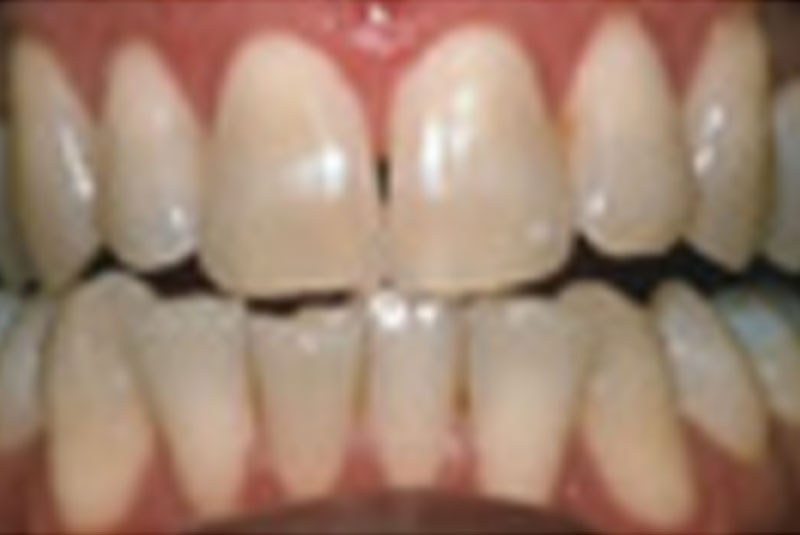 before veneers and teeth whitening