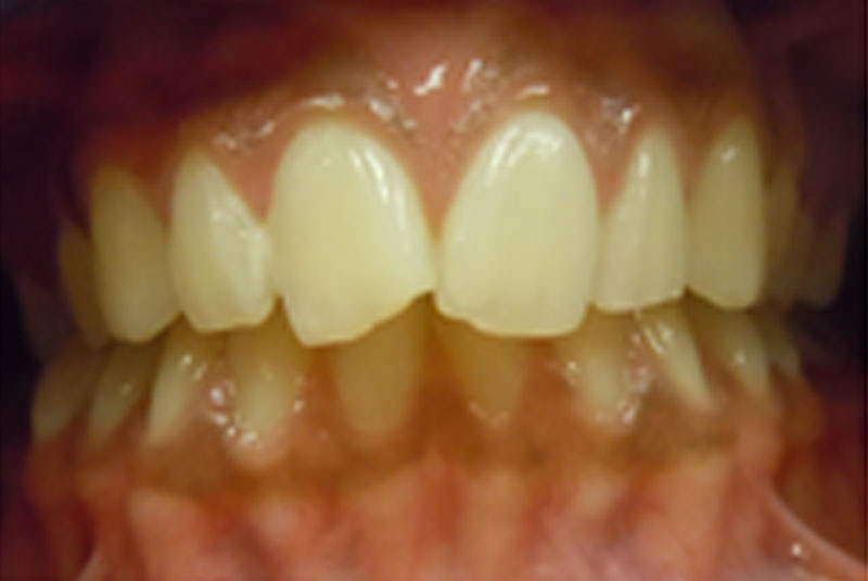 before fast braces