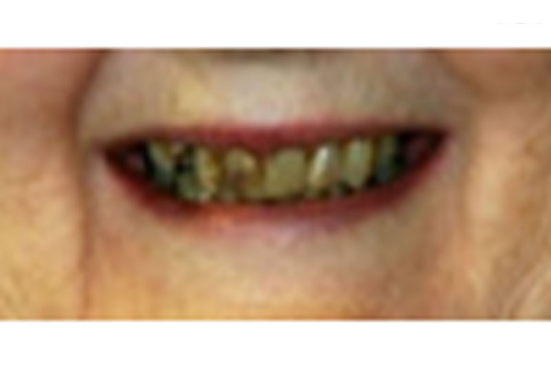 before porcelain crowns