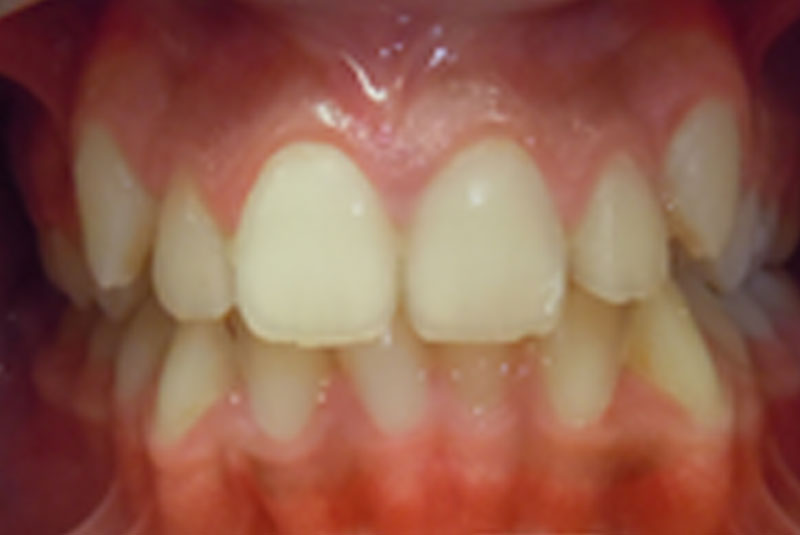 before fast braces