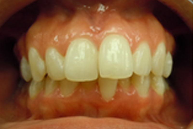 after fast braces