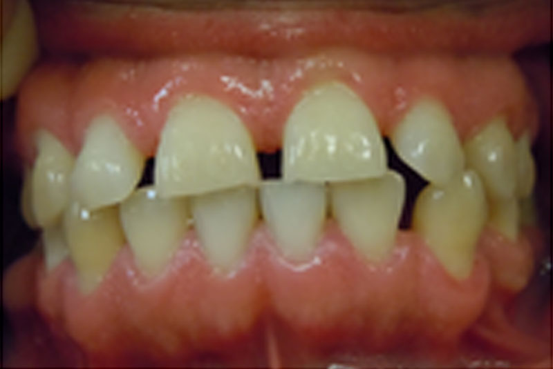 before fast braces