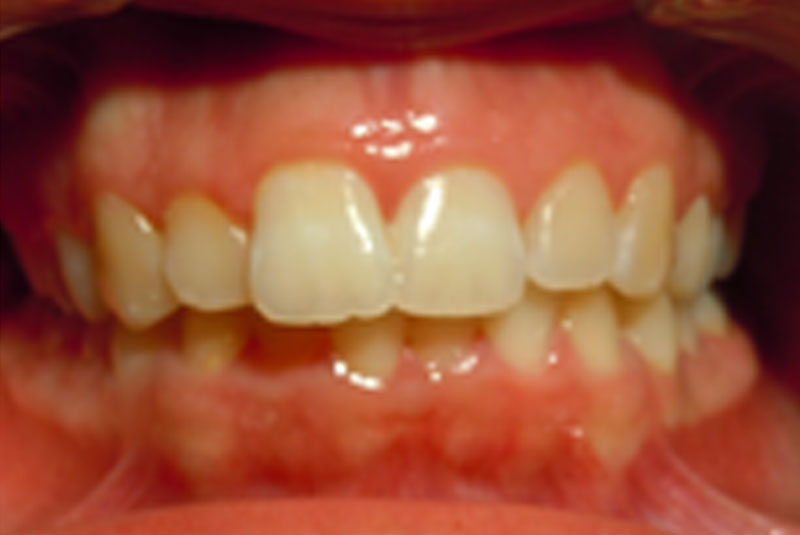 before fast braces