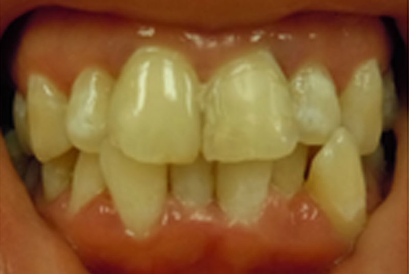 before fast braces