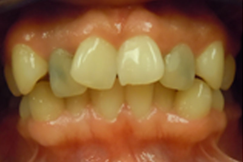 before fast braces