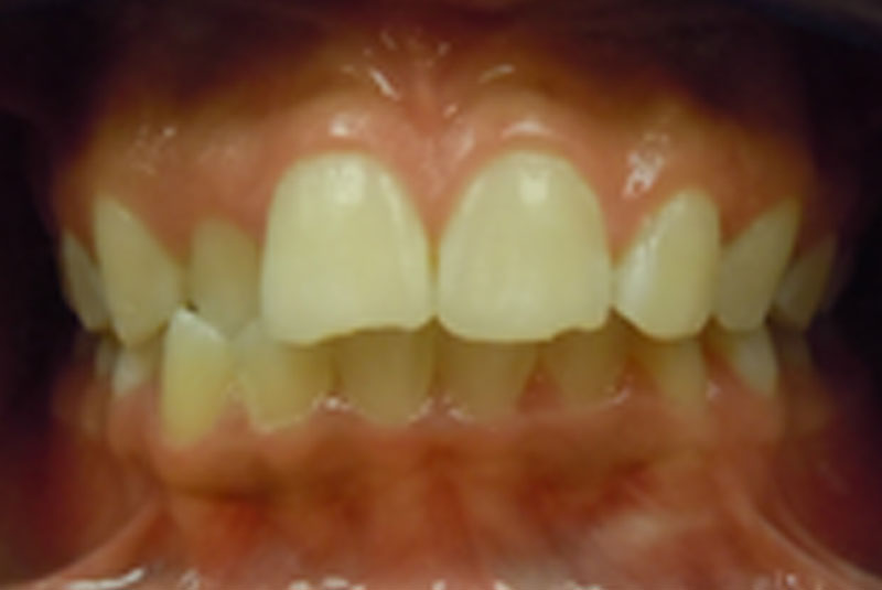 before fast braces