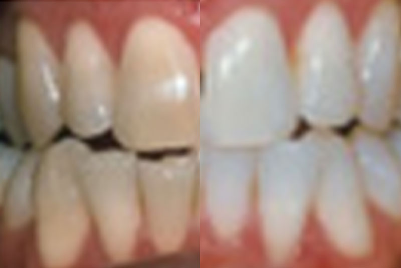 before and after teeth whitening procedure