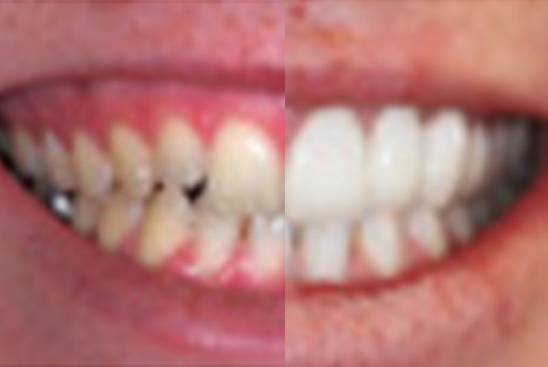 before and after teeth whitening procedure