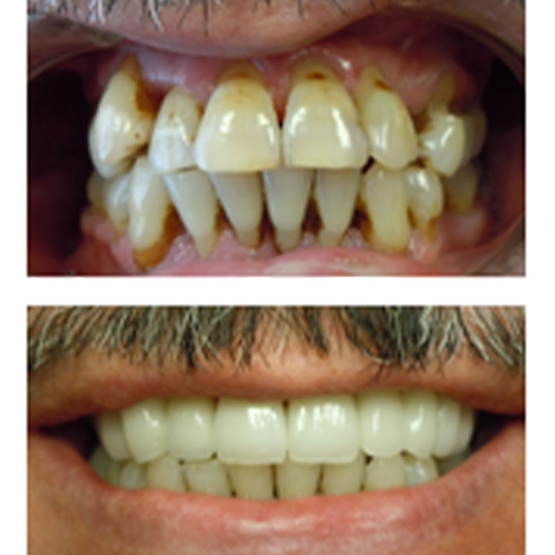 before and after dental procedure
